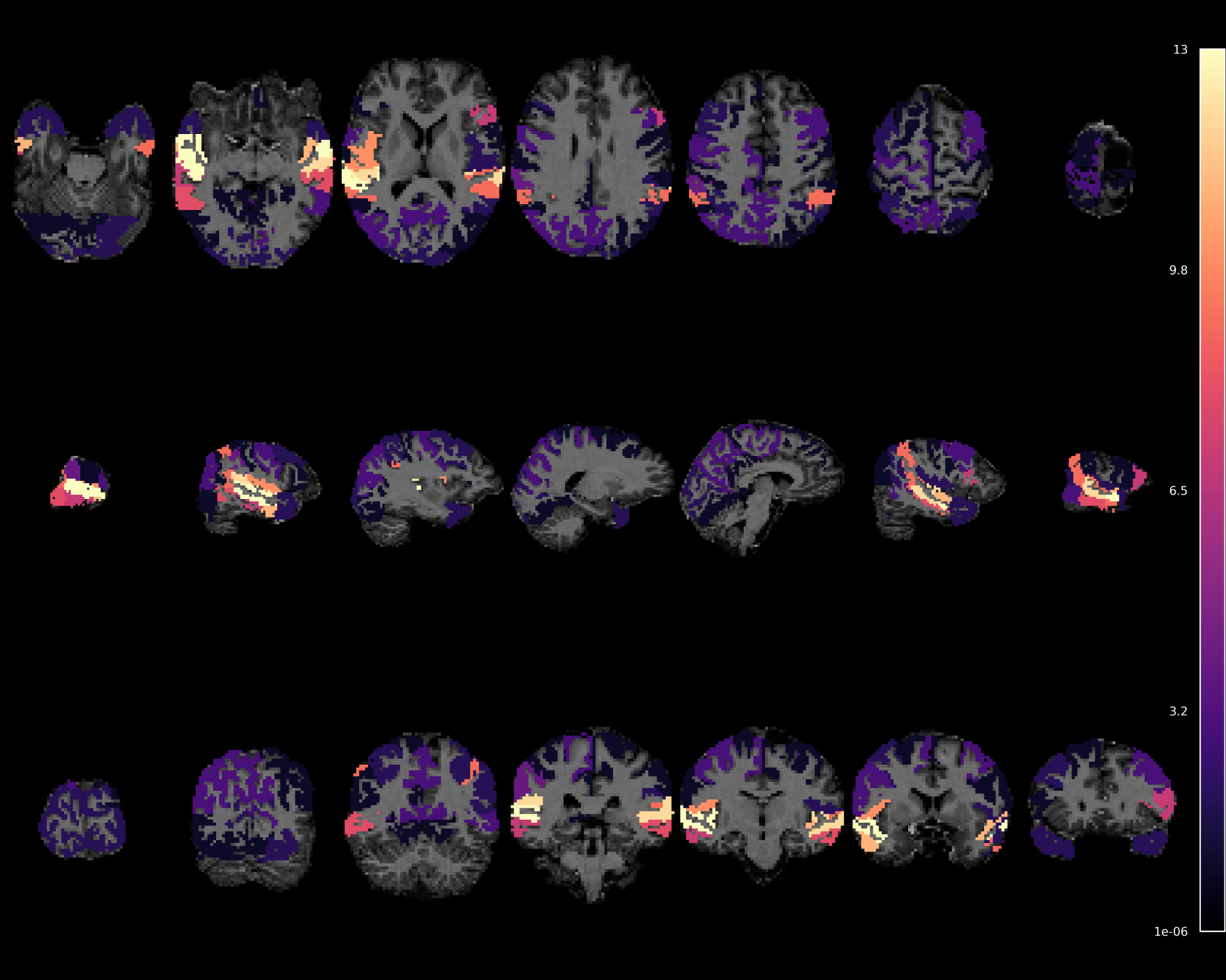 Brain map showing shift responses in peri-Sylvian regions