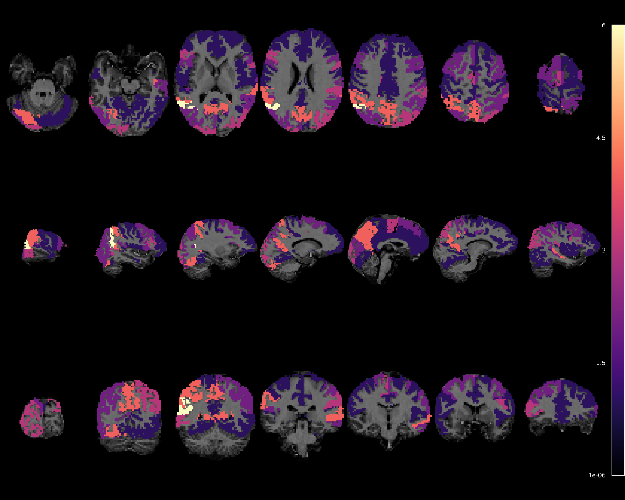 Brain map highlighting drift responses in higher-order default-mode regions